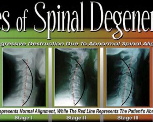 subluxation degeneration