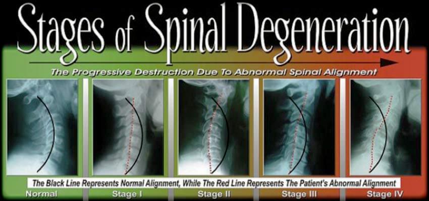 Beyond Wellness Chiropractic Mt Pleasant - subluxation degeneration